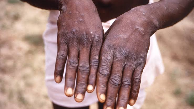 At least 13 African countries have reported Mpox outbreaks : Africa CDC